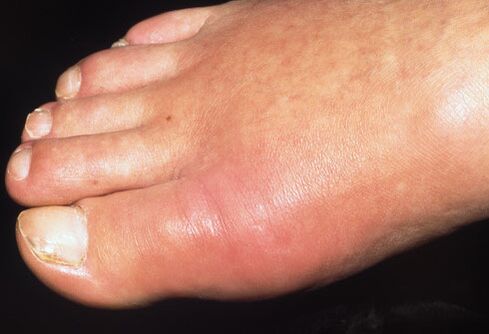 Artrită acută înainte de tratamentul cu spray Hondrox