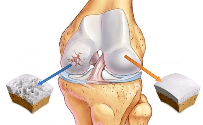cartilaj sănătos și artroza genunchiului
