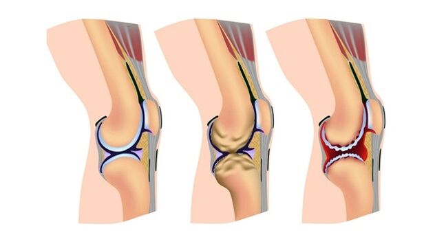stadiile artrozei articulației genunchiului