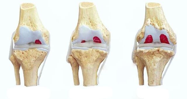 stadiile osteoartritei genunchiului