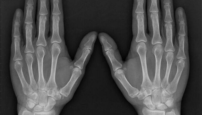 radiografie pentru diagnosticul de artrită și artroză