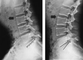 deplasarea vertebrelor în osteocondroza toracică