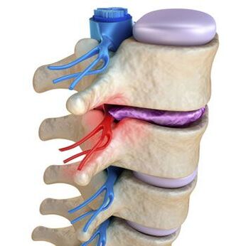 Un nerv ciupit la nivelul coloanei vertebrale este însoțit de durere fulgerătoare