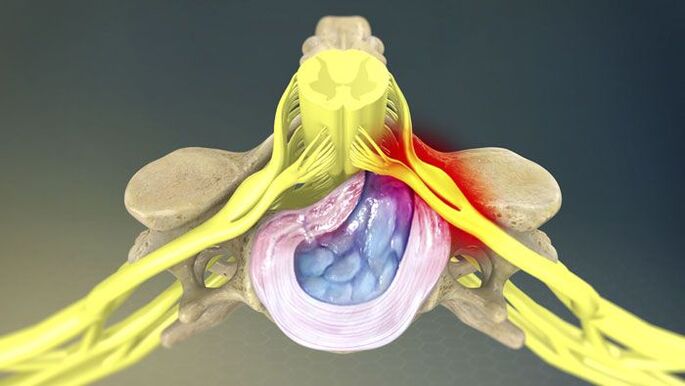 Una dintre cauzele durerii de spate este hernia de disc. 