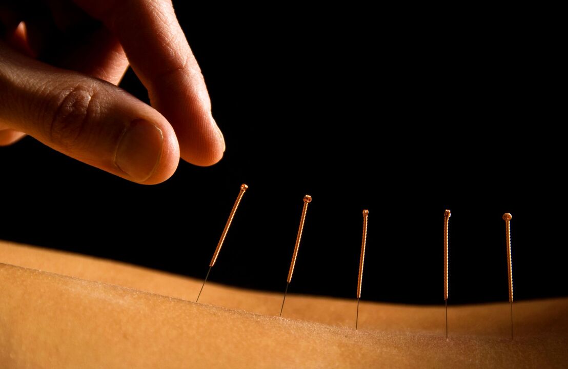 acupunctura pentru durerile de spate