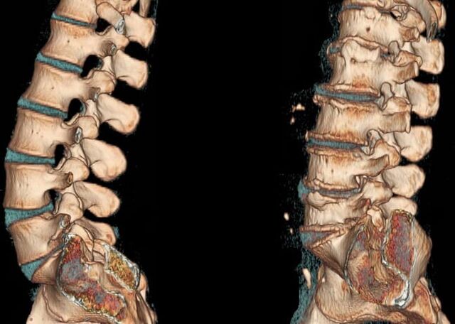 Osteochondroza regiunii lombare