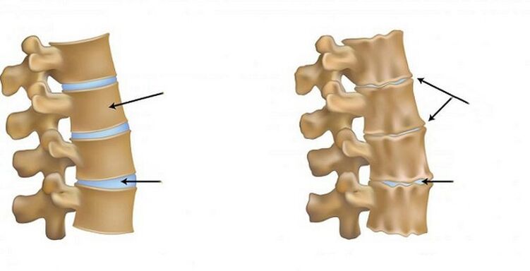 Sindromul ischemic pentru osteochondroză