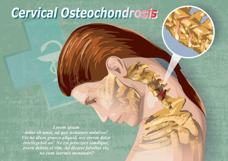 Osteochondroza cervicală este o boală a țesutului cartilajului