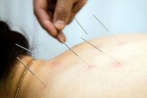 acupunctura pentru osteocondroză