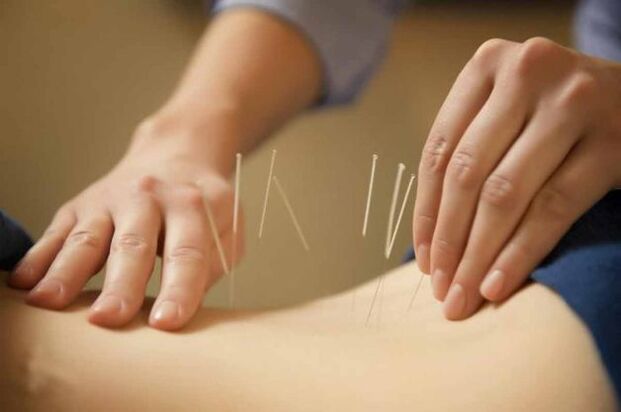 tratamentul osteocondrozei cu acupunctură