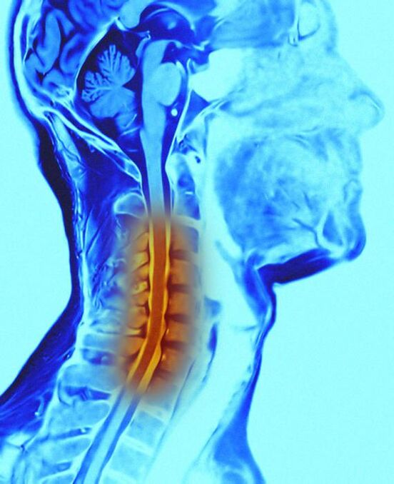 coloana cervicală și osteocondroză
