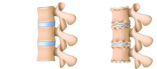 Osteocondroza din interior